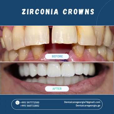 Slider image (5) Universe Dental - Best Dental Clinic in Tbilisi, Georgia